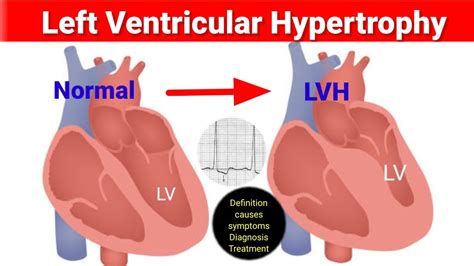 lv of heart|signs of left ventricular hypertrophy.